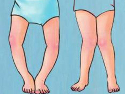 ox腿怎么矫正男生,ox形腿怎么才能瘦成筷子腿