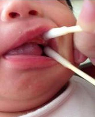 新生婴儿鹅口疮怎么回事,新生儿鹅口疮和正常对比