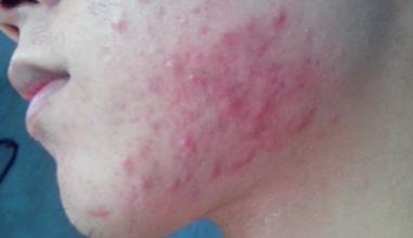 油脂痘该怎么解决,满脸痘怎么调理