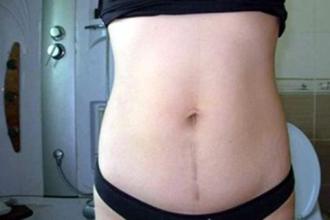 如何照顾剖宫产产妇坐月子,夏天剖宫产后坐月子