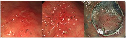 食管高级别上皮内瘤变选择治疗流程