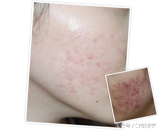 痘痘越来越可怕,记录痘痘生长全过程