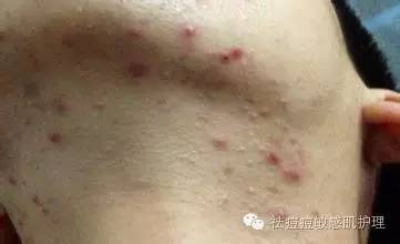 痘痘的形成原因和五大分类,痘痘形成的原因分析