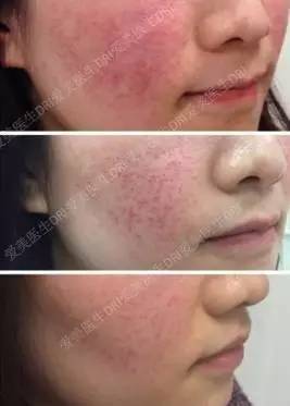 激素依赖性皮炎用什么牌子护肤品 (轻度激素依赖性皮炎用什么护肤品)