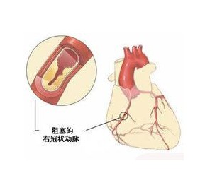 心梗合并三高,心梗血压和血糖会变高吗