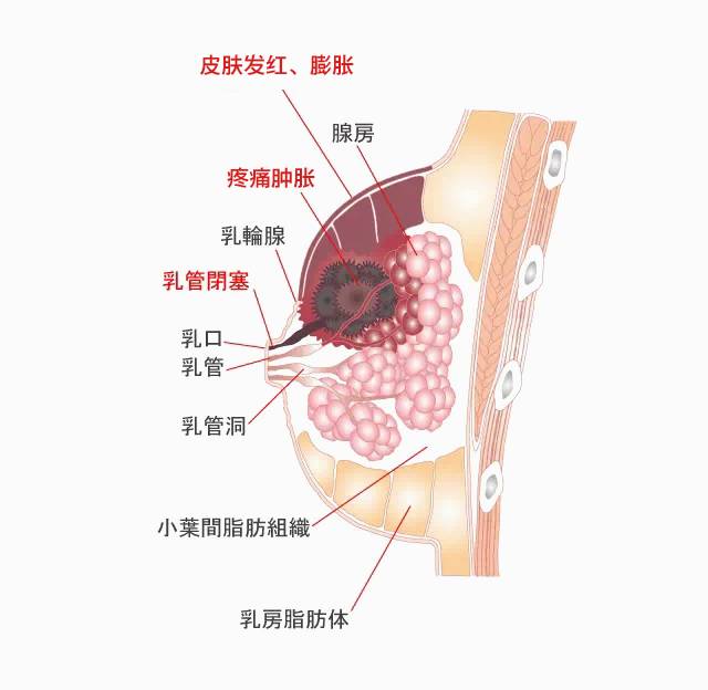 痛！生娃三大酷刑终极Boss乳腺炎之~通关秘籍