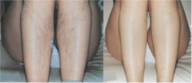 连志玲姐姐都苦恼的唇毛，你知道怎么办吗？