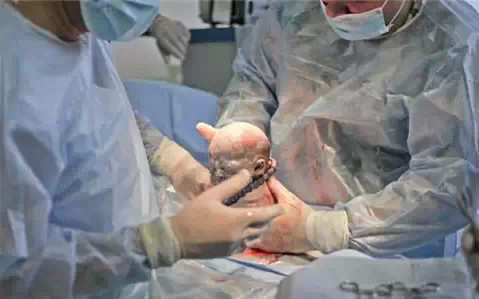 听说剖腹产更轻松？看看过来人怎么说！