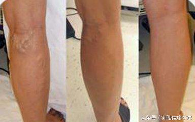 御贴高效果怎么样,肋骨软组织损伤贴什么膏药