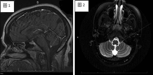 顽固性呕吐是什么意思,反射性呕吐怎么缓解