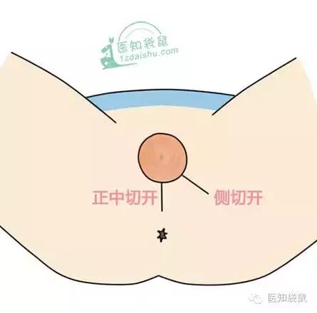 会阴侧切非做不可吗？几招预防方法教给您