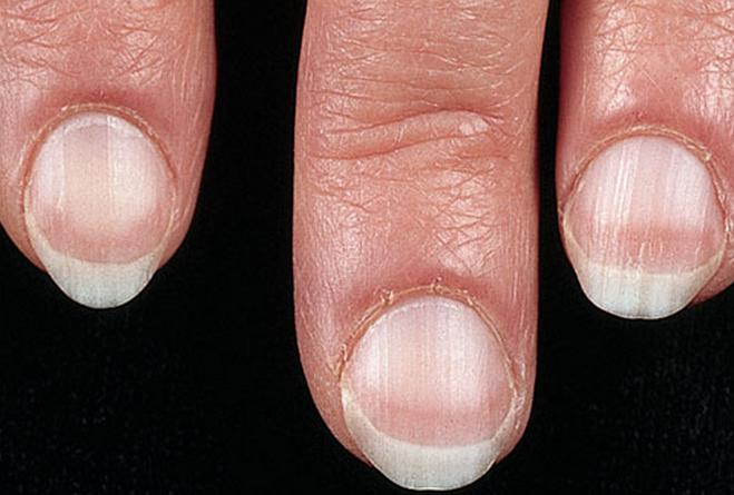 指甲上发现白点,指甲上有白点为什么要看皮肤科