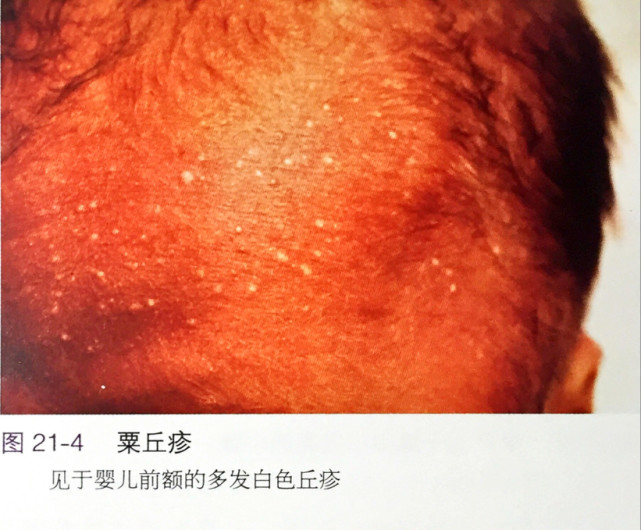 眼睛周围有白色的小点是不是疣,眼睛下边有白点不是脂肪粒是什么