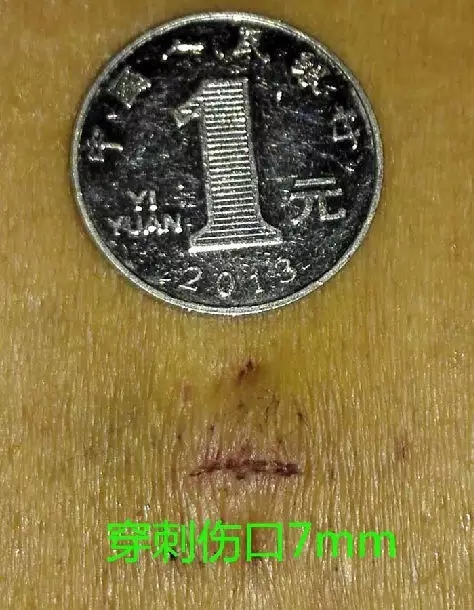 椎间孔镜治疗腰椎间盘突出靠谱吗,腰间盘突出椎间孔镜手术后复发