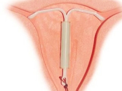 顺产还在出血可以上环吗,生孩子大出血后可以上环吗