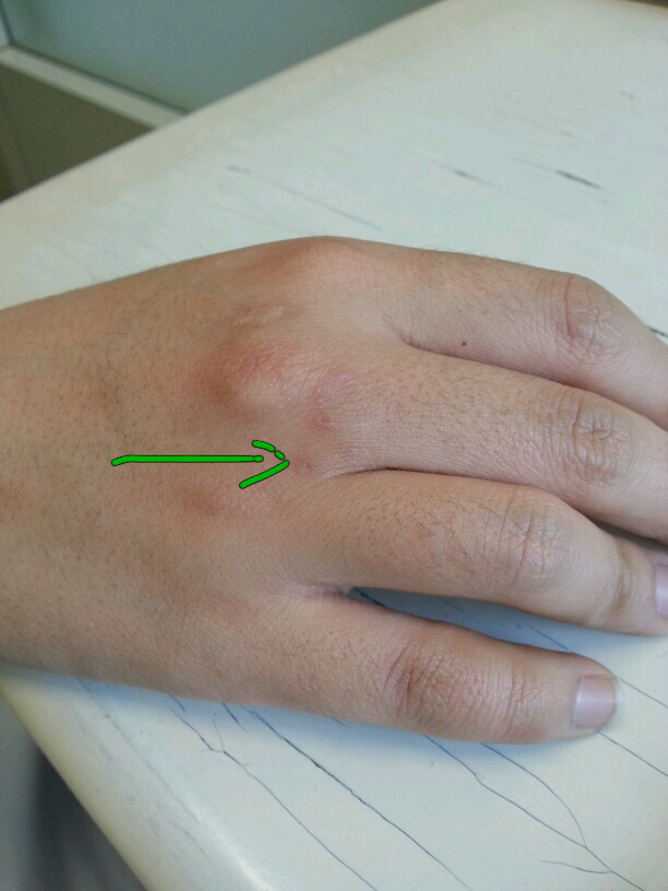 被猫抓伤是患狂犬病还是猫抓病,被小猫抓伤会得狂犬病吗伤口很浅