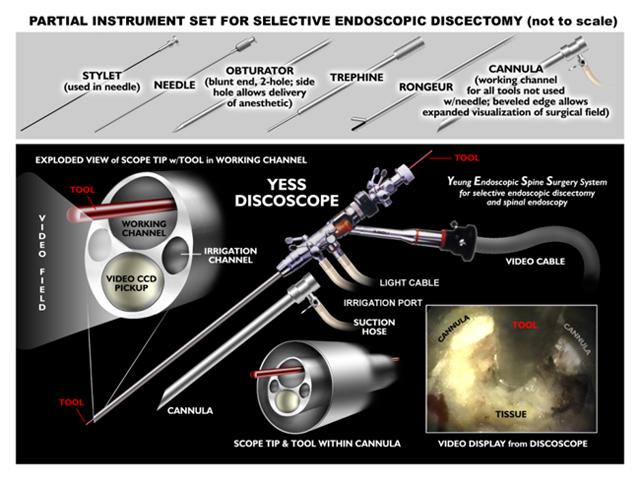 微创手术治疗腰椎间盘突出成功率,目前最热门腰椎微创技术椎间孔镜