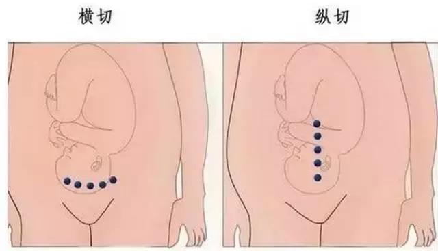 横切剖宫产后的疤痕,剖腹产横切和竖切二年愈合照片
