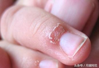 宝宝手指有倒刺缺什么微量元素,宝宝手指脱皮是缺什么