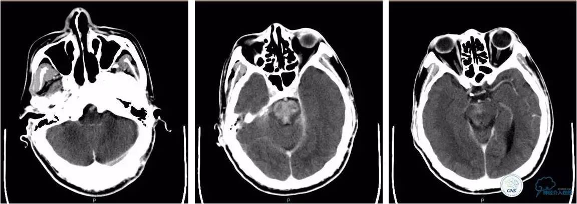 后循环系统梗死,后循环梗死