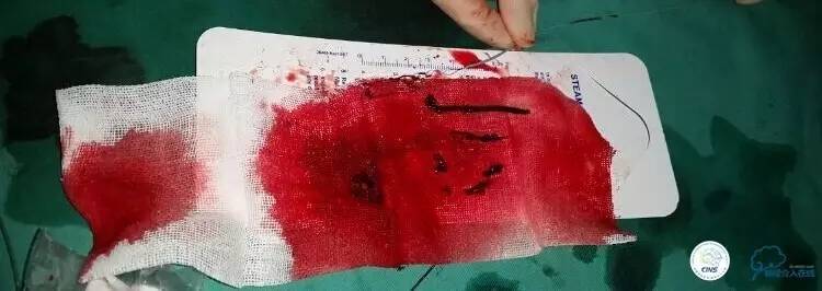 下肢血栓微创介入治疗的费用,急性深静脉血栓形成的诊断和治疗