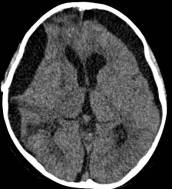 周忠清颅咽管瘤全切的终身复发率,周忠清谈颅咽管瘤术后寿命