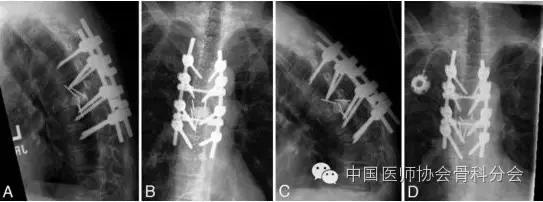 骨科经典案例分享,骨科微创实例