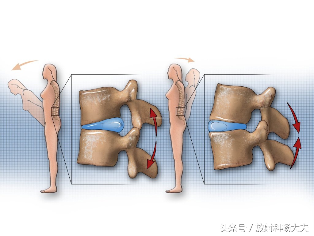 除了腰间盘突出其它哪儿都不突出,椎间盘膨出和脱出的区别