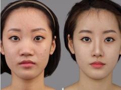 鼻子不好看能改善吗,大鼻子不好看怎么办