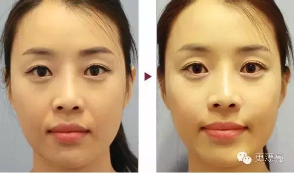 爱笑的女孩只有法令纹,果然爱笑的女孩法令纹很重了