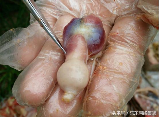 感冒和腺肌胃炎的混感治疗方案