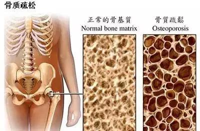 骨科专家讲座骨密度如何提高,骨科医生谈骨密度峰值年龄