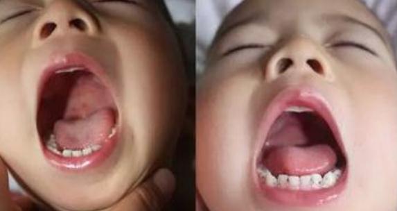 儿童疱疹病毒怎么治疗根除,如何预防儿童单纯疱疹