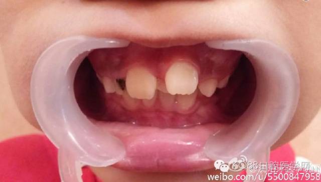 揭秘孩子是如何长出两层牙齿的？