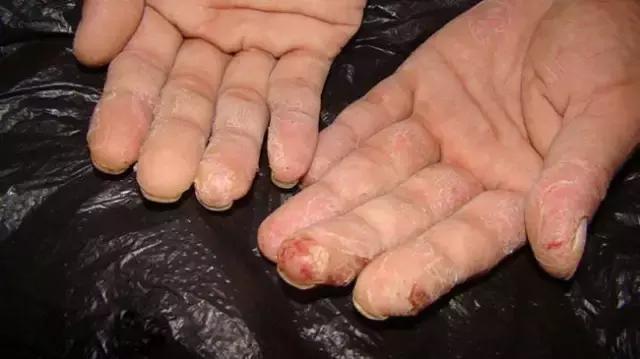 香虎烧手如何治疗的,香虎手能彻底治好吗