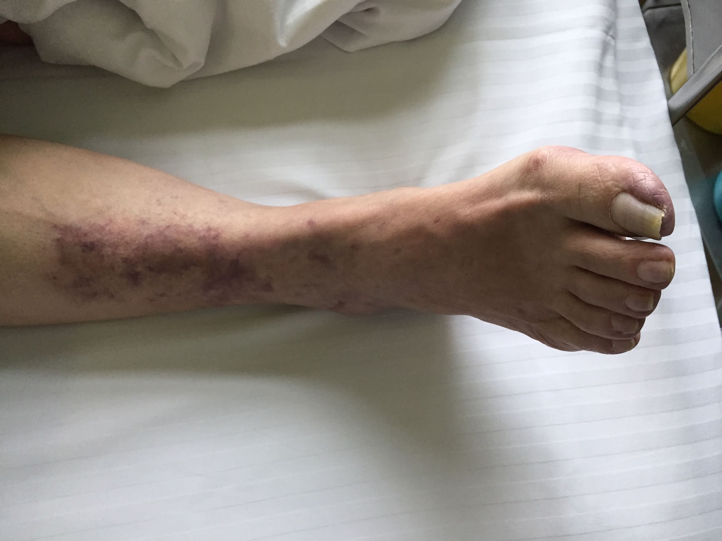 下肢血管病变怎样治疗可以修复,下肢血管病变的症状及表现