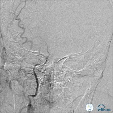 右侧大脑中动脉区可见两支血管,什么是左侧大脑中动脉代偿供血