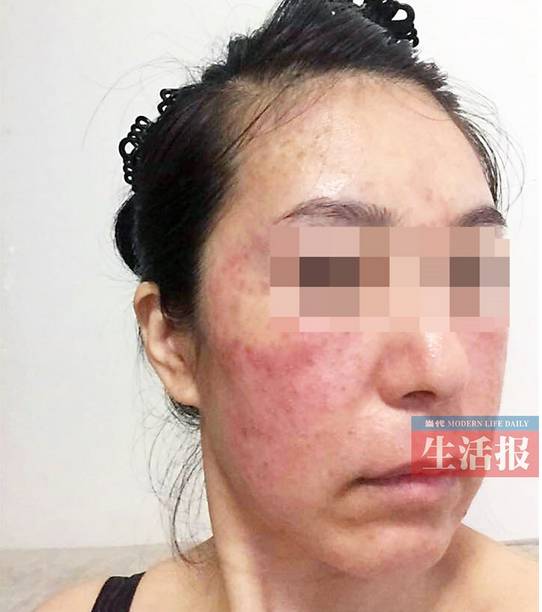 药水点痣毁容,诊所点痣毁容