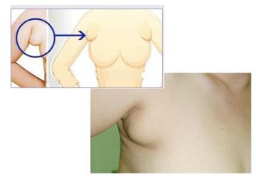 产后副乳有疙瘩是堵奶了吗,产后副乳是淋巴结堵了吗