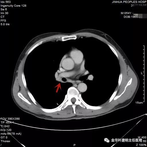 省级医院也漏诊?还好没耽误病情!我们予以行右中下叶袖式切除术
