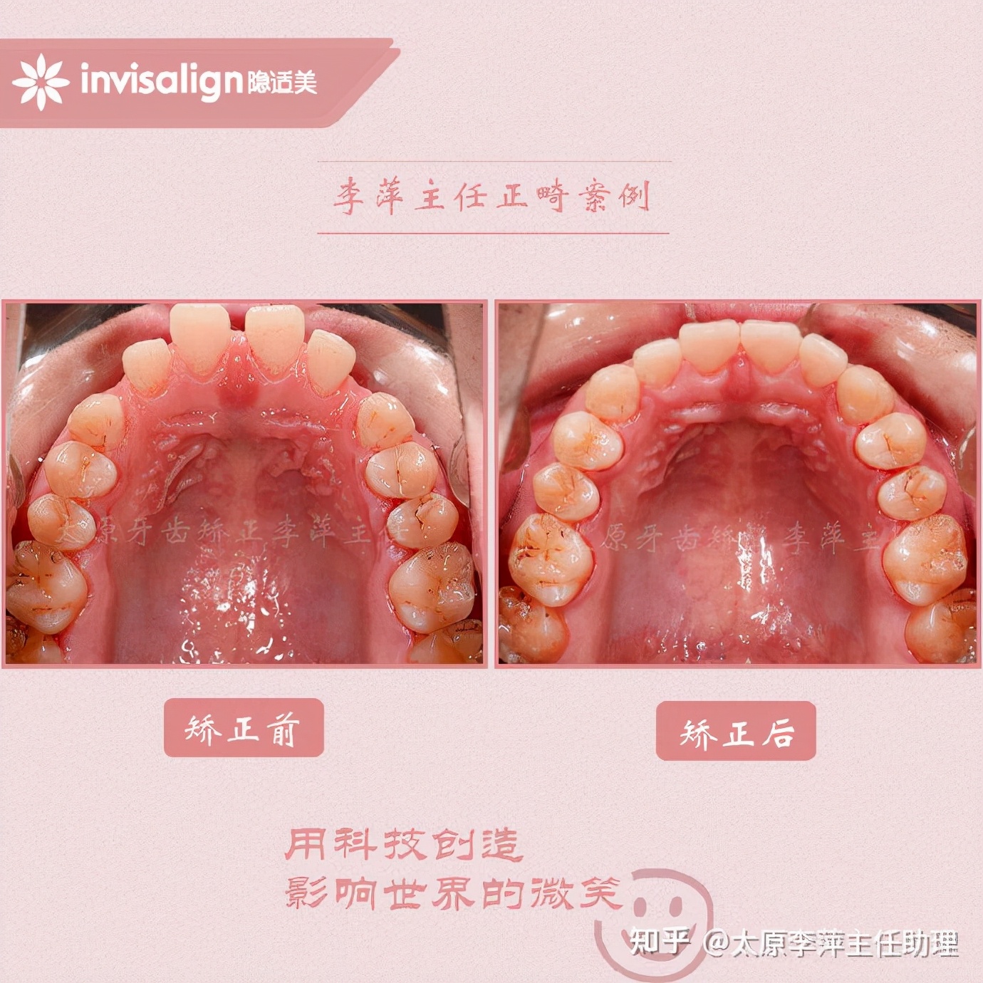 重度拥挤矫正牙齿适合隐形牙套吗,广州成人牙齿矫正推荐隐形牙套