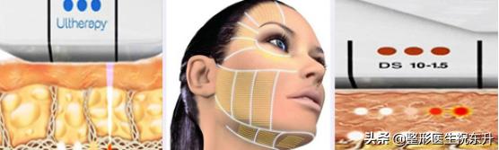 超声炮做了之后脸部有凹陷怎么办,超声炮刚做完脸部凹陷是怎么回事