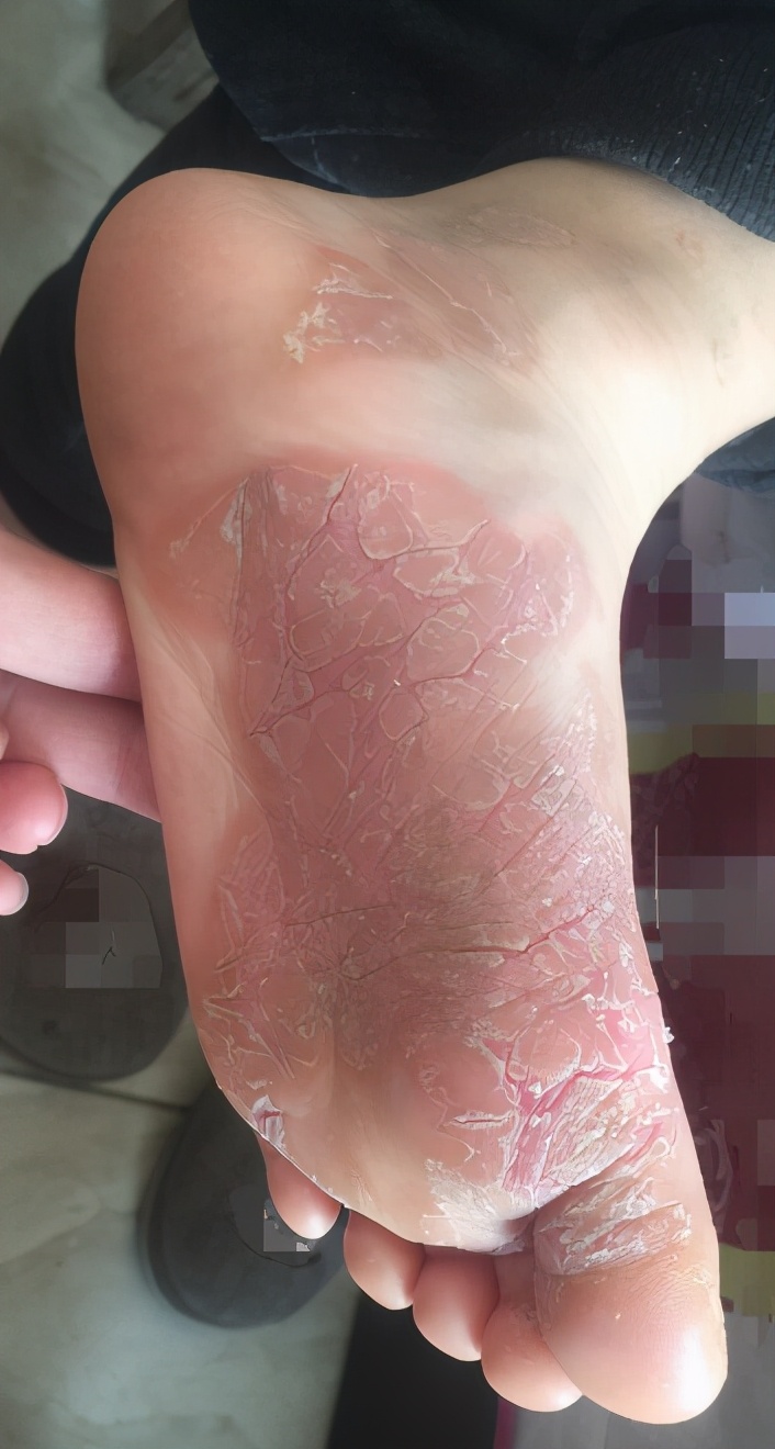 泡醋可以治手足癣,泡醋能治脚臭吗