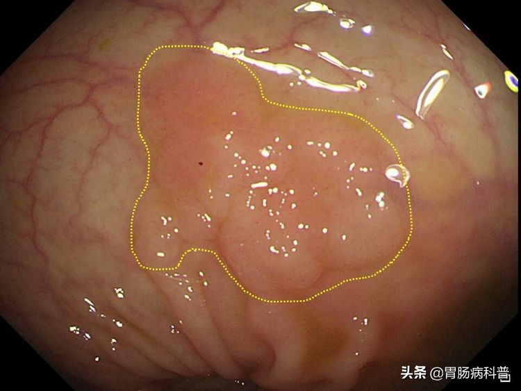 结肠癌会代代相传吗,结肠癌肝转移