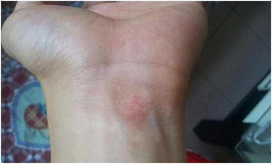 女大学生为约会，被一瓶香水下了“白斑咒”，白癜风可要注意了