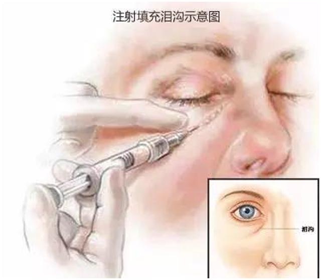 关于泪沟告诉你三个绝招,新手好上手的遮泪沟方法