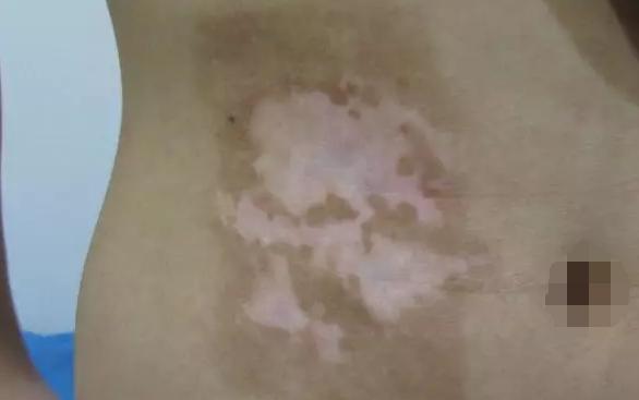 白癜风黑色素完全脱失还能恢复吗,白癜风黑色素脱失怎么激活