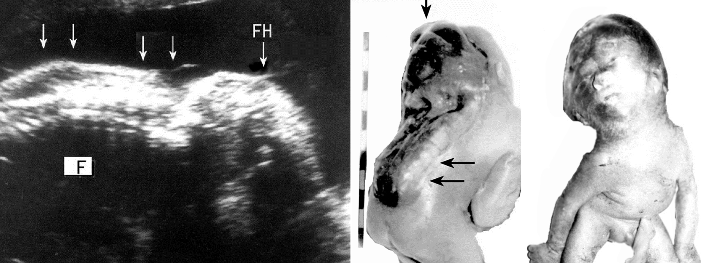 明明白白做超声25-5：胎儿神经管缺陷—脊柱裂