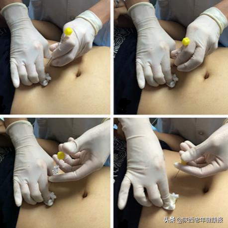 针灸减肥常识大全,减肥不可盲目针灸减肥了解一下