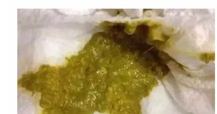 新婴儿大便怎样才是正常的,新生儿宝宝大便怎么判断是否正常